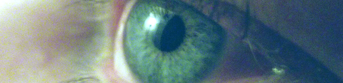 Irritated Eyes with Contact Lenses