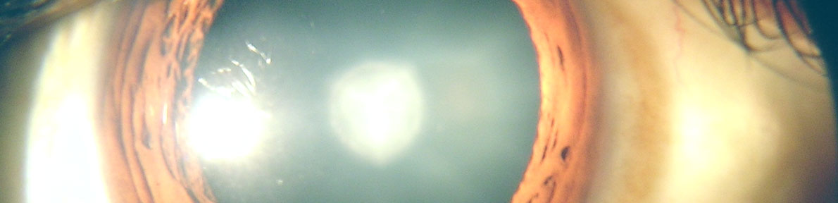 Cataracts - Eye Problem